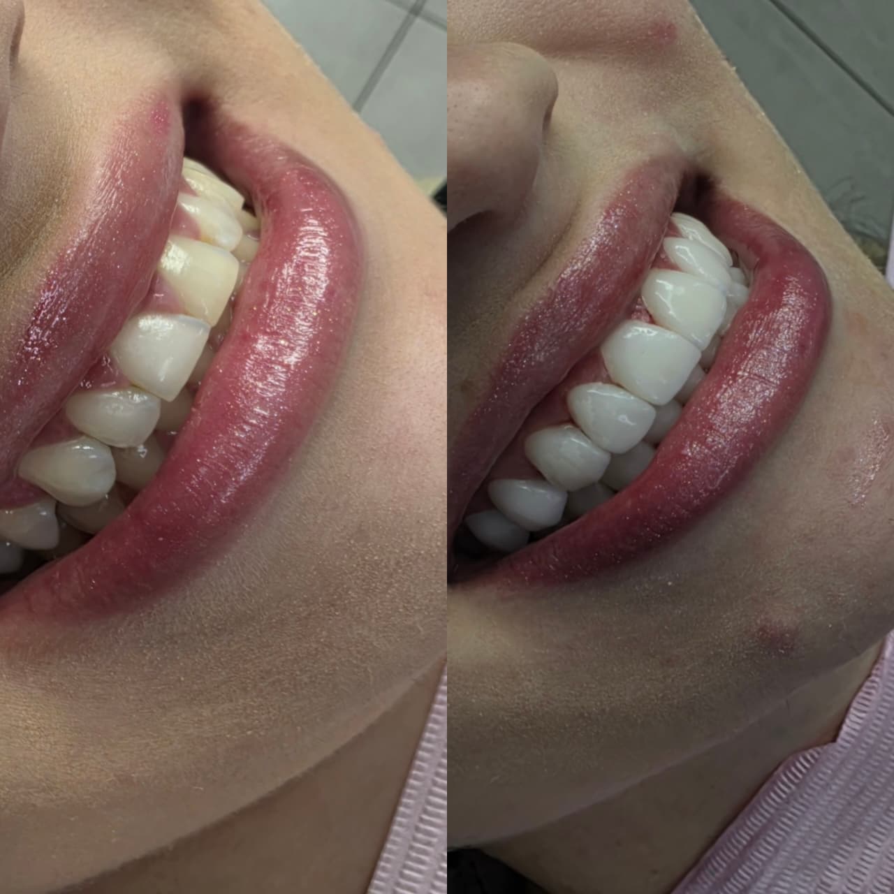 Antes e depois de Facetas