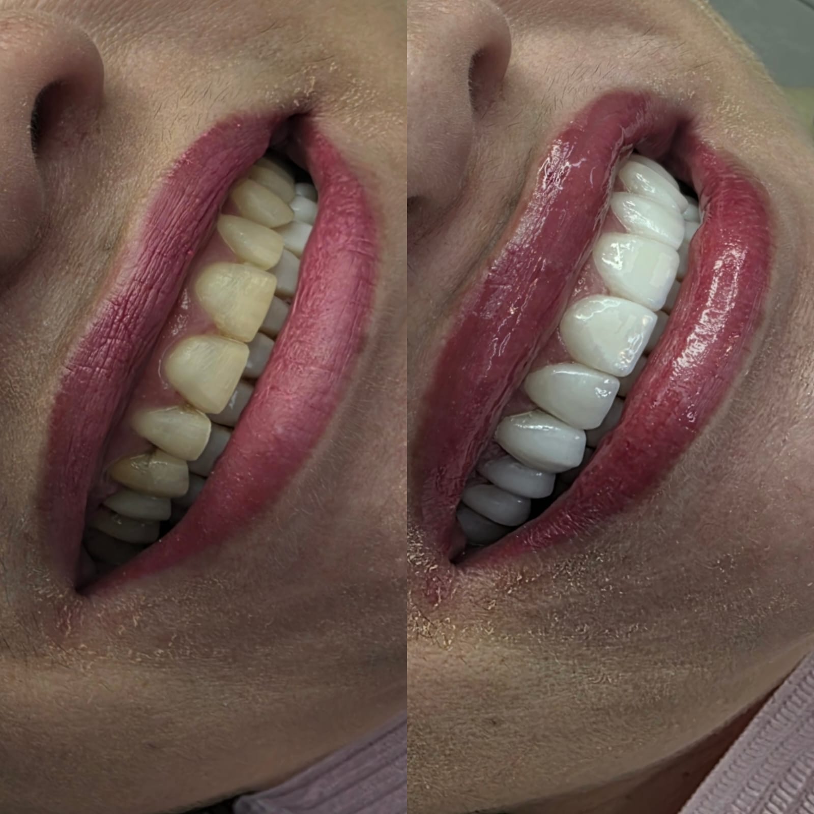 Antes e depois das lentes de contato dental