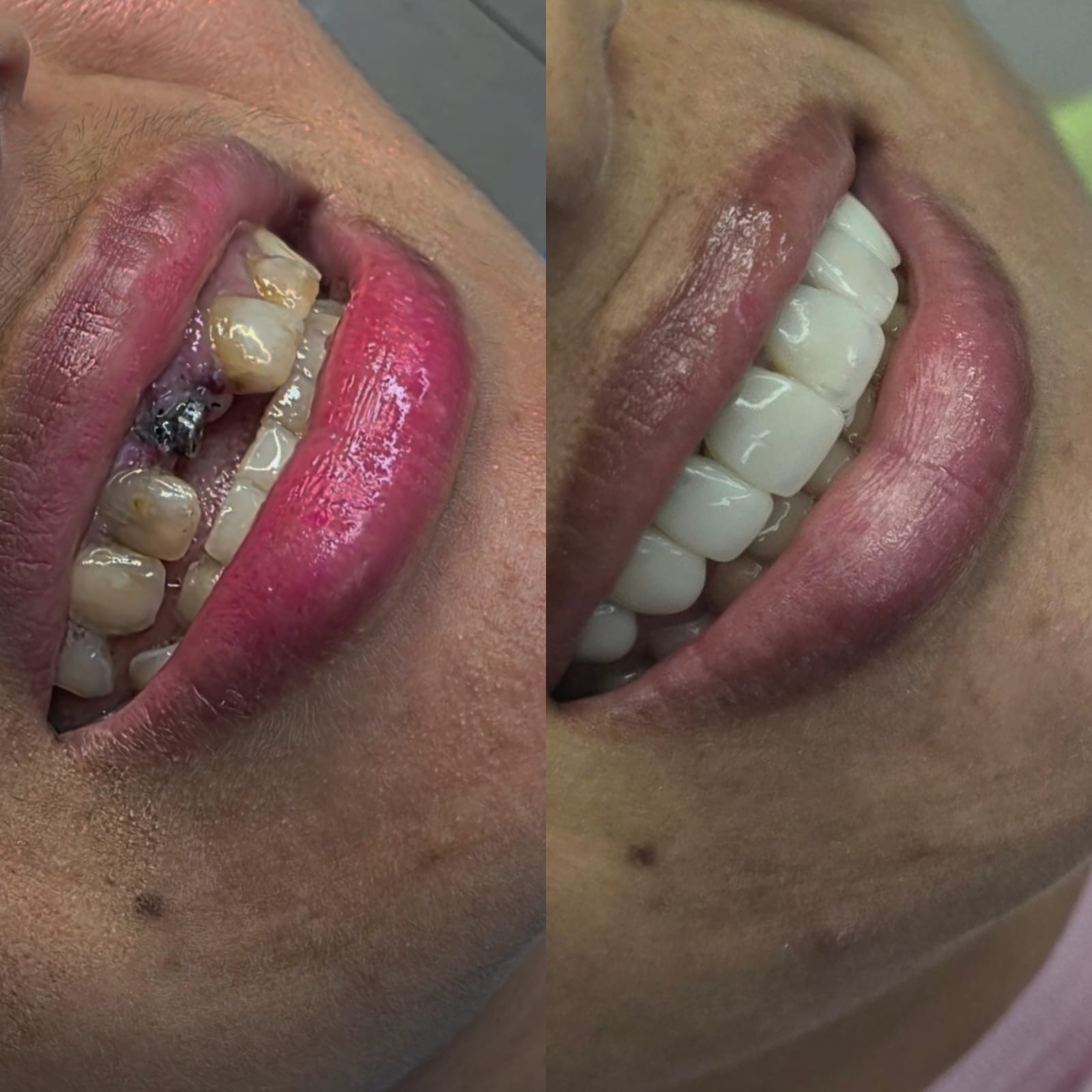 Antes e depois do implante dentário