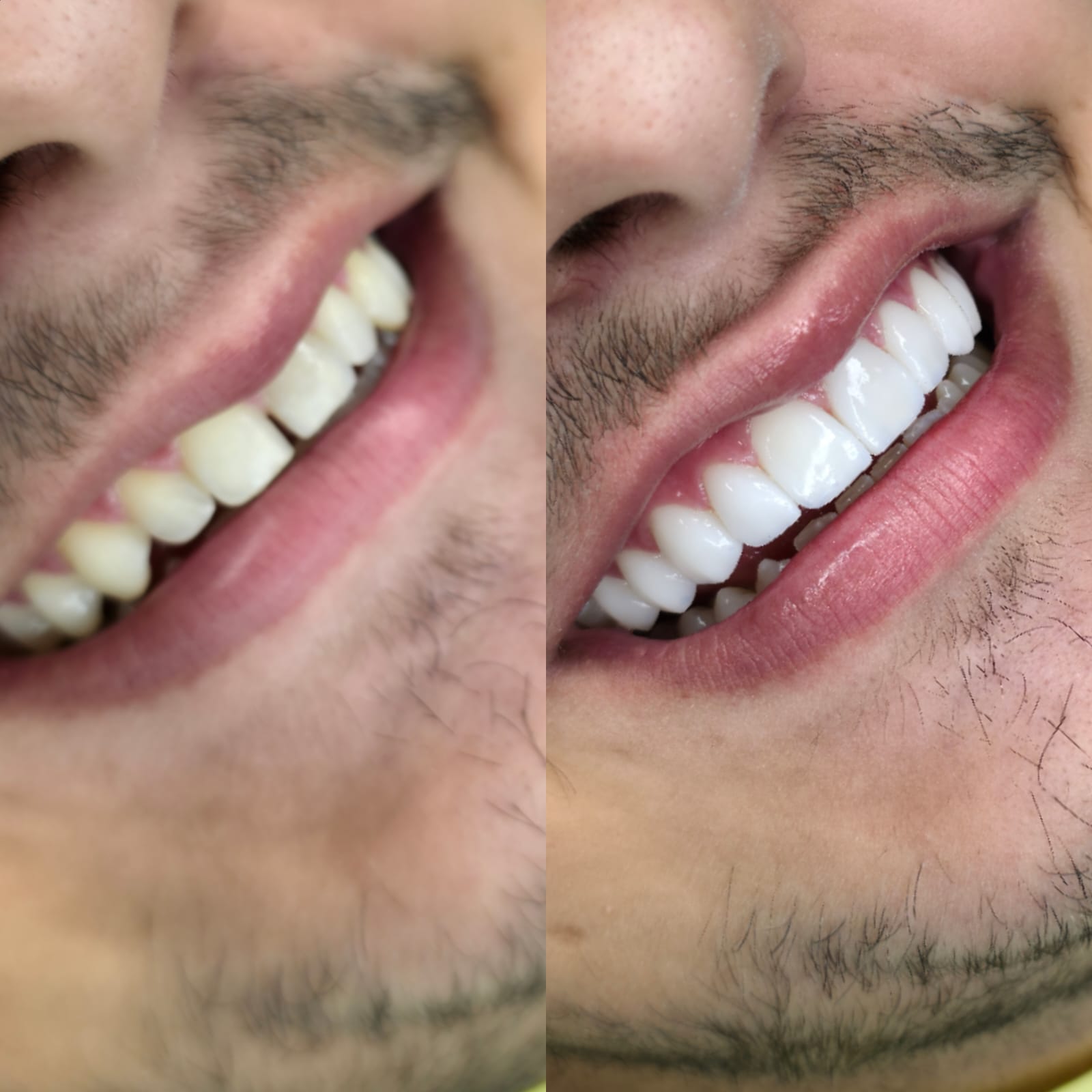 Antes e depois de Lentes em porcelana