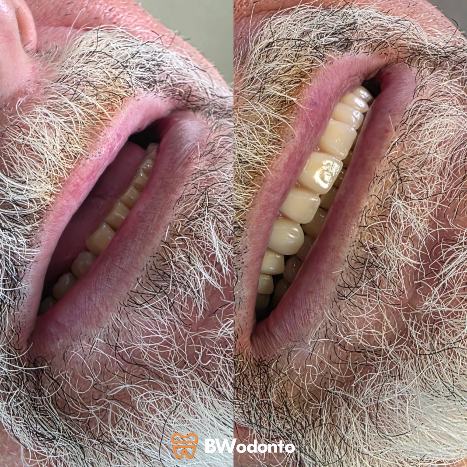 Antes e depois de Prótese