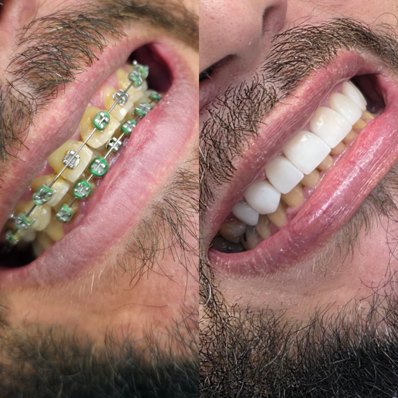 Antes e depois do tratamento ortodôntico